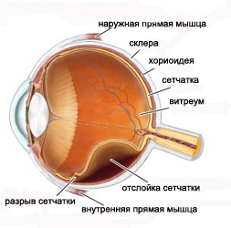 Отслоение сетчатки Витреоретинальная патология - отслоение сетчатки