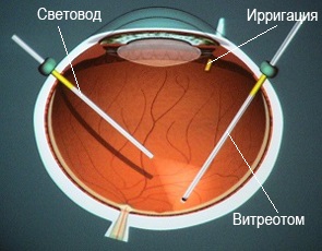 Макулярное отверстие операция Схема проведения витрэктомии при разрыве макулы