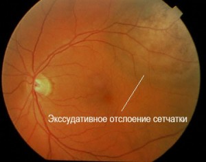 Серозное отслоение сетчатки. Хориоидальная меланома Экссудативное отслоение сетчатки