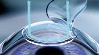 Lasik