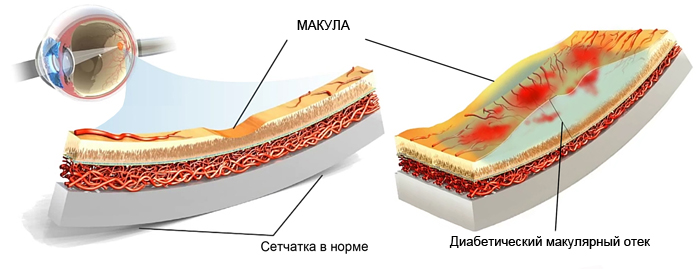 диабетический макулярный отек