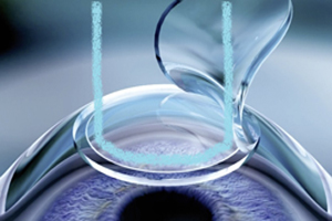 Фемто ЛАСИК — Femto Lasik