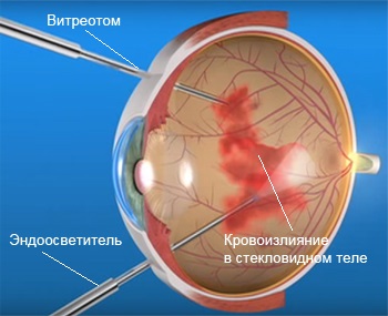 Техника микроинвазивной витрэктомии Витрэктомия при кровоизлиянии в стекловидном теле