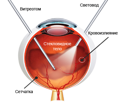 Витрэктомия - основной метод лечения кровоизлияния в стекловидное тело Кровоизлияние в стекловидное тело - лечение. Витрэктомия