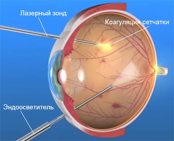Эндолазеркоагуляция сетчатки при витреоретинальной операции Лазерная коагуляция сетчатки в ходе витрэктомии