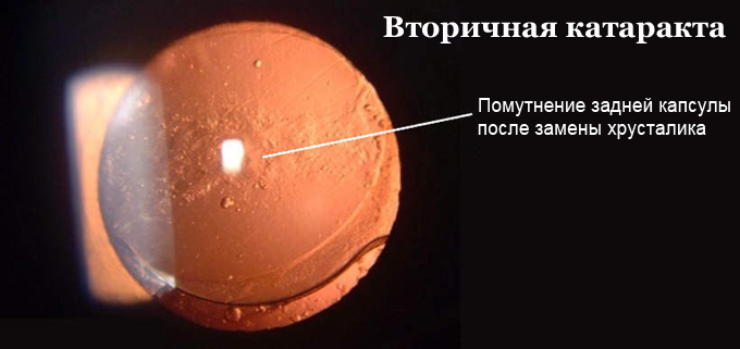 Вторичная катаракта - помутнение задней капсулы хрусталика Вторичная катаракта