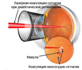 Лазерное лечение диабетического макулярного отека